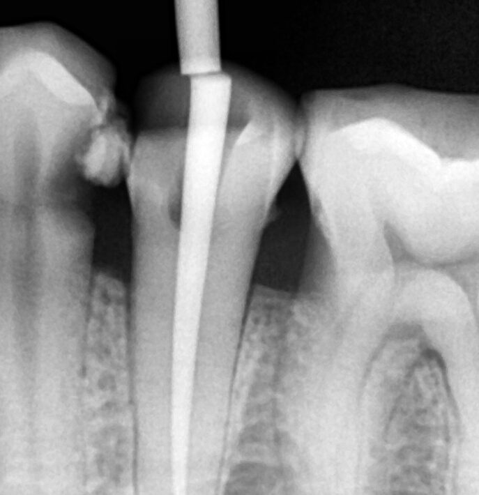 Root Canal Specialist in Mumbai