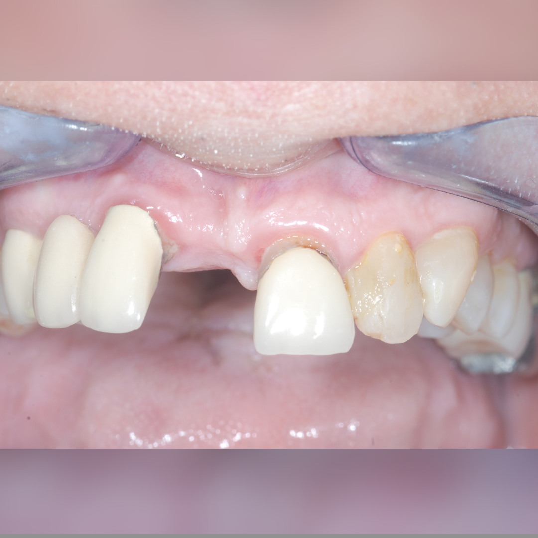 Teeth Whitening in Mumbai