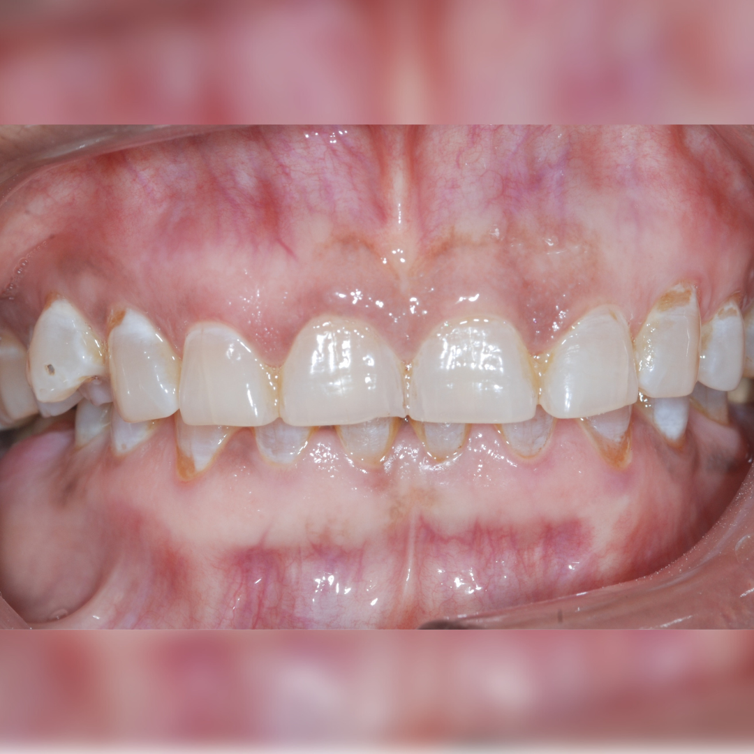 Teeth Whitening in Mumbai
