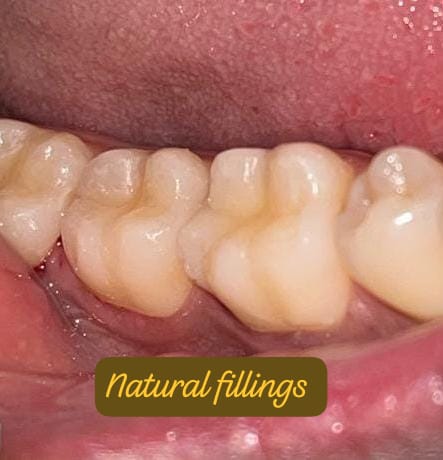 Root Canal Specialist in Mumbai