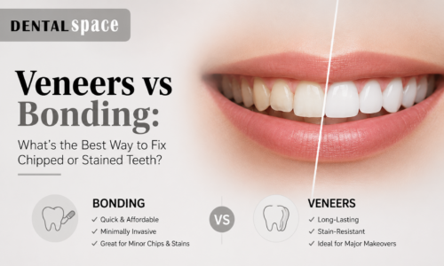 Dental Veneers vs. Bonding - Dental Space
